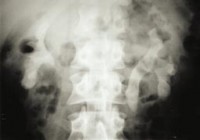 coral shaped nephrolitiasis coral shaped nephrolitiasis